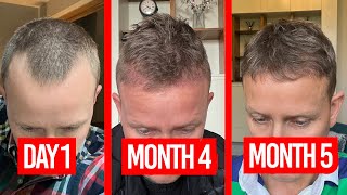 I got a hair transplant  - 6 month update