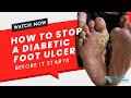 Preventing Houston Diabetic Foot Ulcer