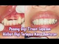 Pemasangan Gigi Tiruan Lepasan Elastis Di Pasien Post Aksiden Gigi Terlepas Utuh|Denture Post Avulsi