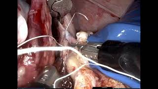 V08-01: The World’s First Single-Port Robotic Simultaneous Kidney and Pancreas Transplantation