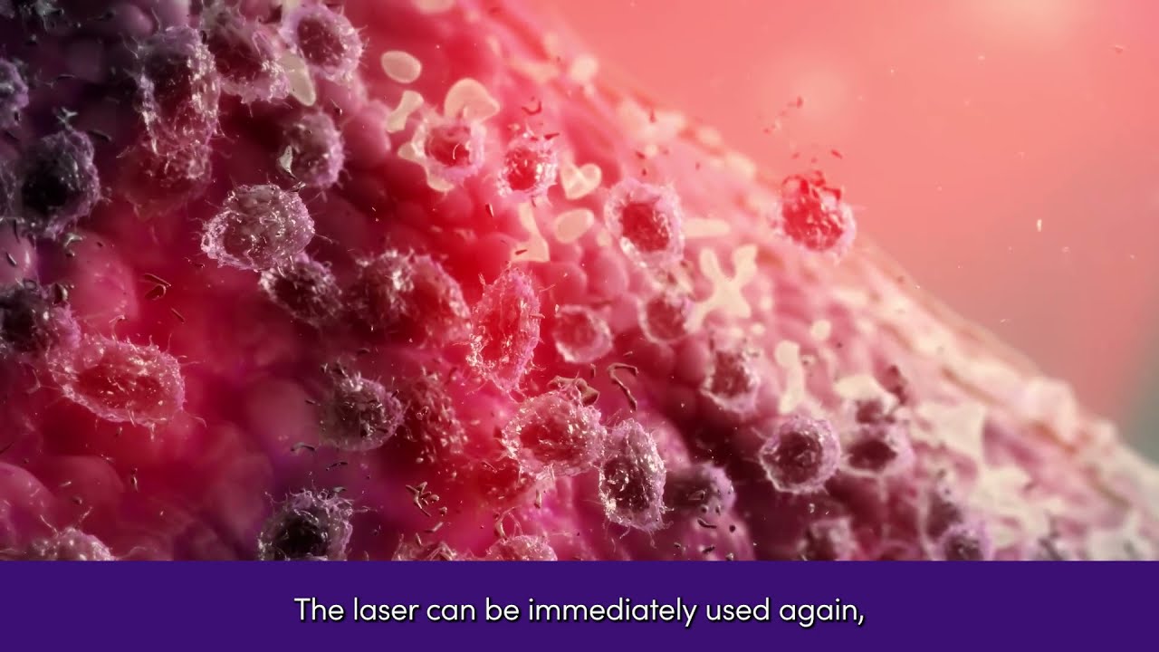 Cosmetic Laser Dermatology  San Diego on Instagram Check out this tattoo  removal treatment utilizing the NEW RESONIC  Its Rapid Acoustic Pulse  technology is the only FDAcleared device that uses sound