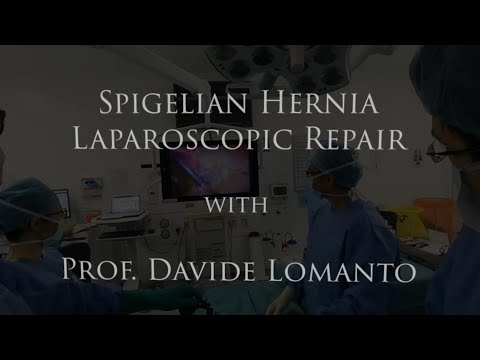 Laparoscopic Repair of Spigelian Hernia by Davide Lomanto Web360 TEASER