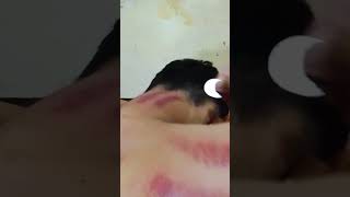 Kerokan Leher Remaja 5