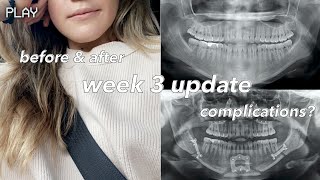 JAW SURGERY | the real struggle - vlog 3 weeks post op