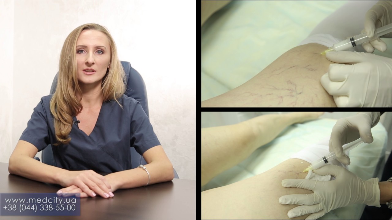 ⁣Склеротерапия для удаления сосудов