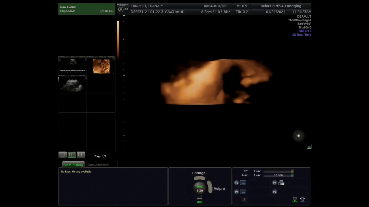 2D 3D 4D Ultrasound YouTube