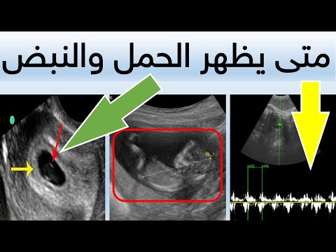 متى يظهر كيس الحمل في السونار متى يظهر الجنين متى يظهر نبض الجنين بالسونار حساب أسابيع الحمل