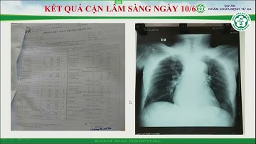 Hội chẩn BN đợt cấp COPD, viêm phổi, suy tim, bệnh tim TMCB, rung nhĩ I BV Bạch Mai