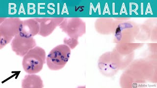 Babesiosis vs Malaria (Babesia microti vs Plasmodium falciparum & vivax) Microbiology Parasitology screenshot 1