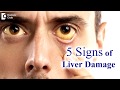 Liver disease symptoms in adults 5 signs your liver is damaged  dr ravindra b s  doctors circle