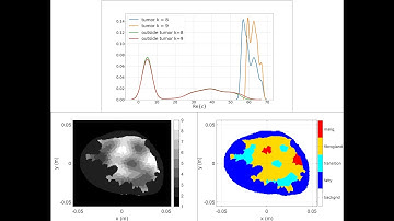 Heterogeneously dense breast: Detailed demo of iterative unsupervised ML segmentation technique
