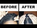 HOW TO GET RID OF DRY ITCHY SCALP IN 15 MINS WITHOUT WASHING YOUR LOCS