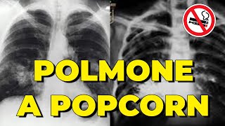Popcorn Lung from E-Cigarettes