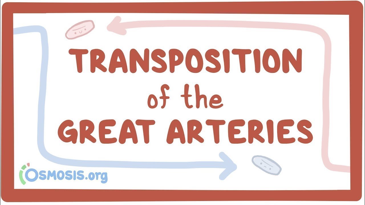 Transposition of the great arteries (TGA) - an Osmosis Preview
