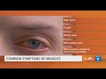 What are the common symptoms of measles?