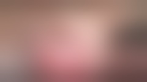 Surgical Management of a Subluxed IOL-Capsular Bag Complex