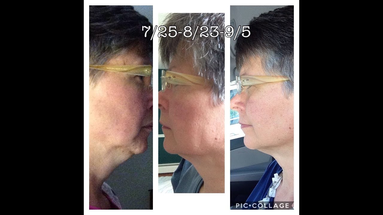 Фасциобластинг для разглаживания морщин и обвисания щек