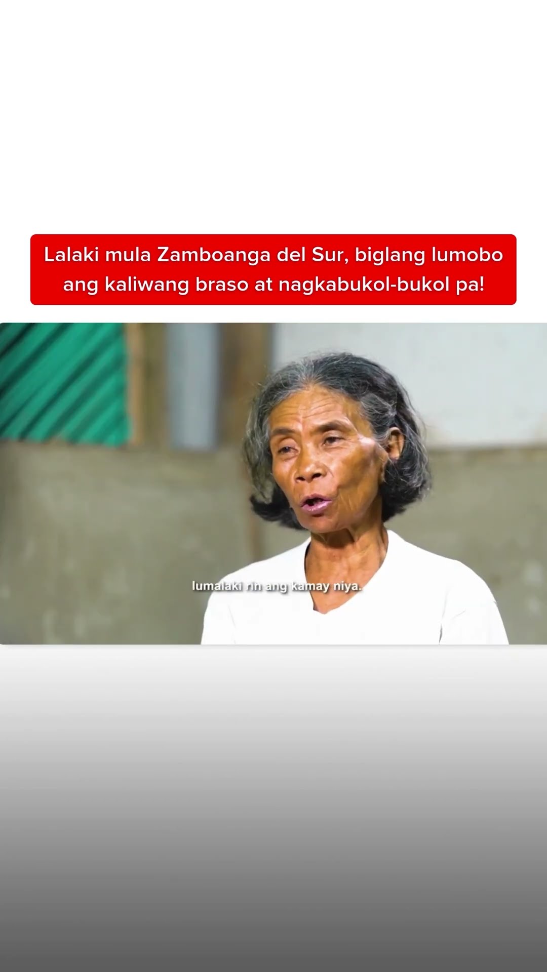 Lalaki, biglang lumobo ang kaliwang braso at nagkabukol-bukol pa! | Kapuso Mo, Jessica Soho