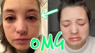 ALLERGIC REACTION | SWOLLEN EYES | ECZEMA FLARE UP | INFECTED ECZEMA!