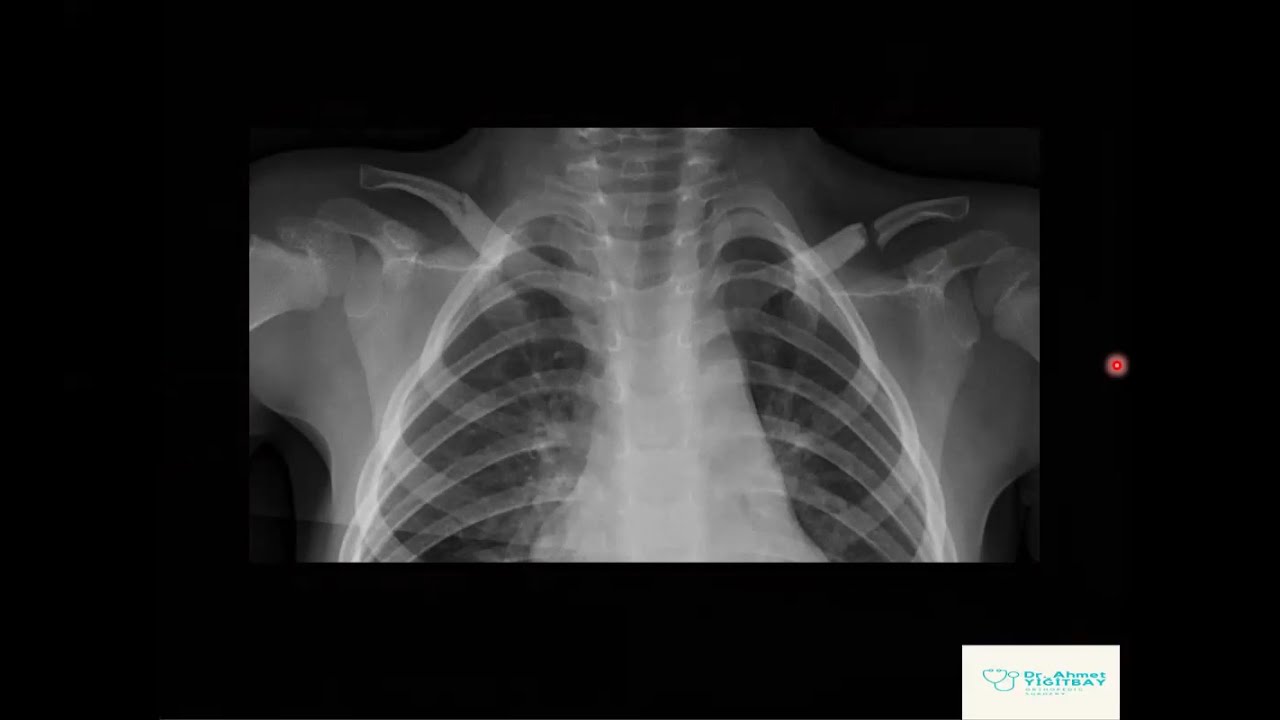 Pediatrik Omuz Röntgeni Yorumlama Teknikleri