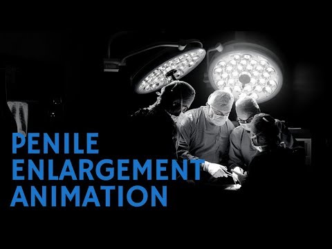 Penuma Penile Enlargement Implant Surgery Animation Video