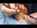 Tenotomy extensor tendon of foot