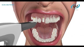 Online-Dental.uk - IPD2004 Scan Abutments and Digital Libraries