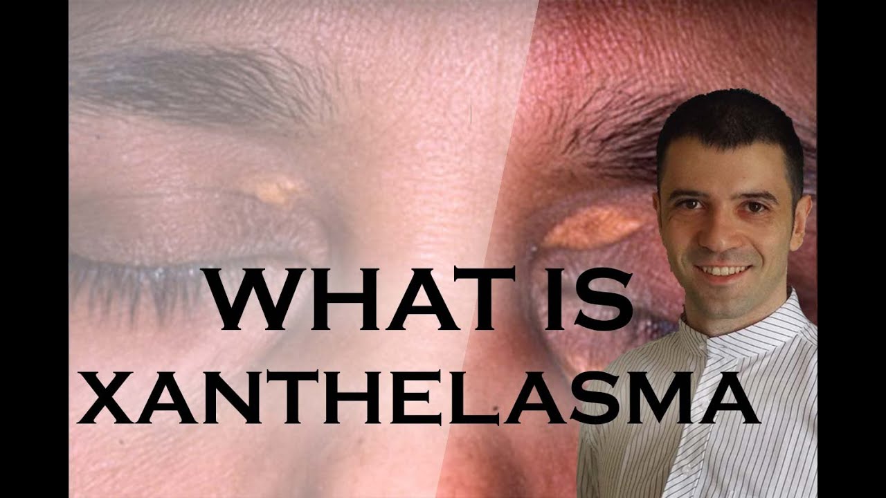 What Is Xanthelasma Youtube