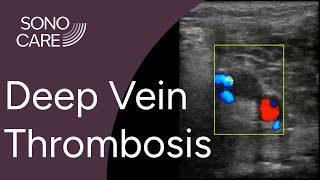 Deep Vein Thrombosis (DVT) Studies