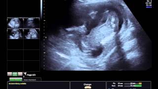 懷孕14周稍微可以判斷出性別 蘋果健康咬一口