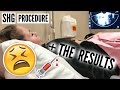 MY SHG PROCEDURE & THE RESULTS