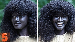 5  People With Unique Skin Colors