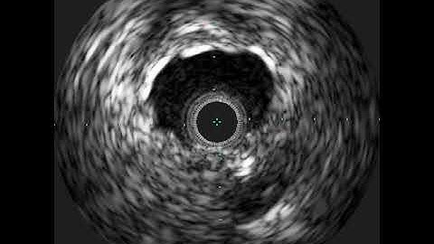 Girişim Prosedürü (video 9)