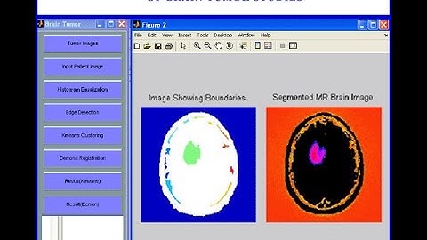 Multiscale Modeling for Image Analysis of Brain Tumor Studies Matlab Project