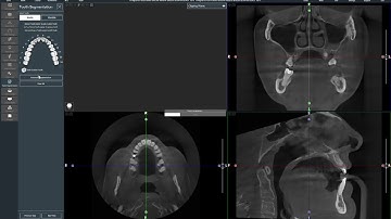 Acteon Tooth Segmentation using Artificial Intelligence - Quick Demo