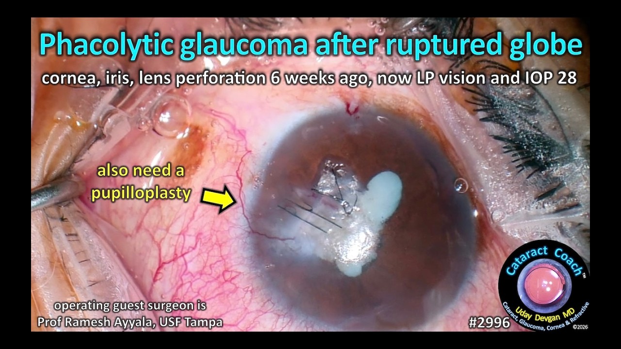 Phacolytic Glaucoma Management After Ruptured Globe