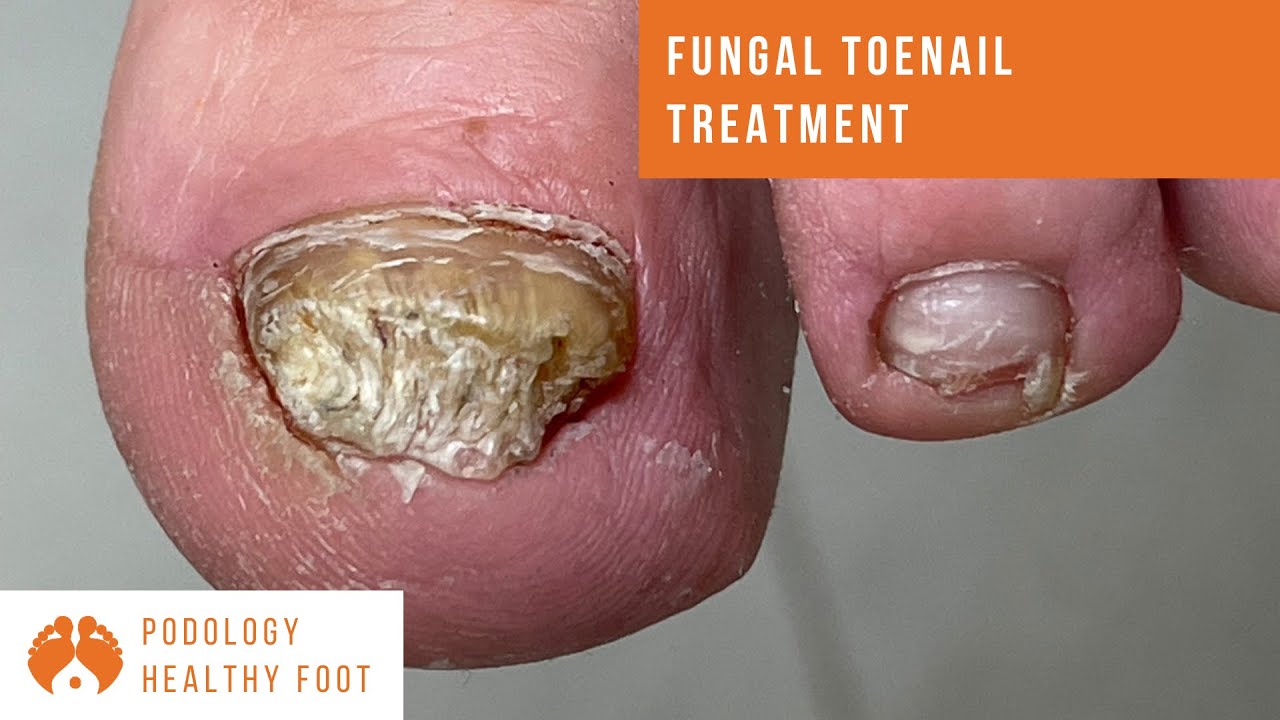 Fungal toenail treatment ***in a Relaxing ASMR*** YouTube