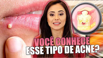 O que é acne grau 1?