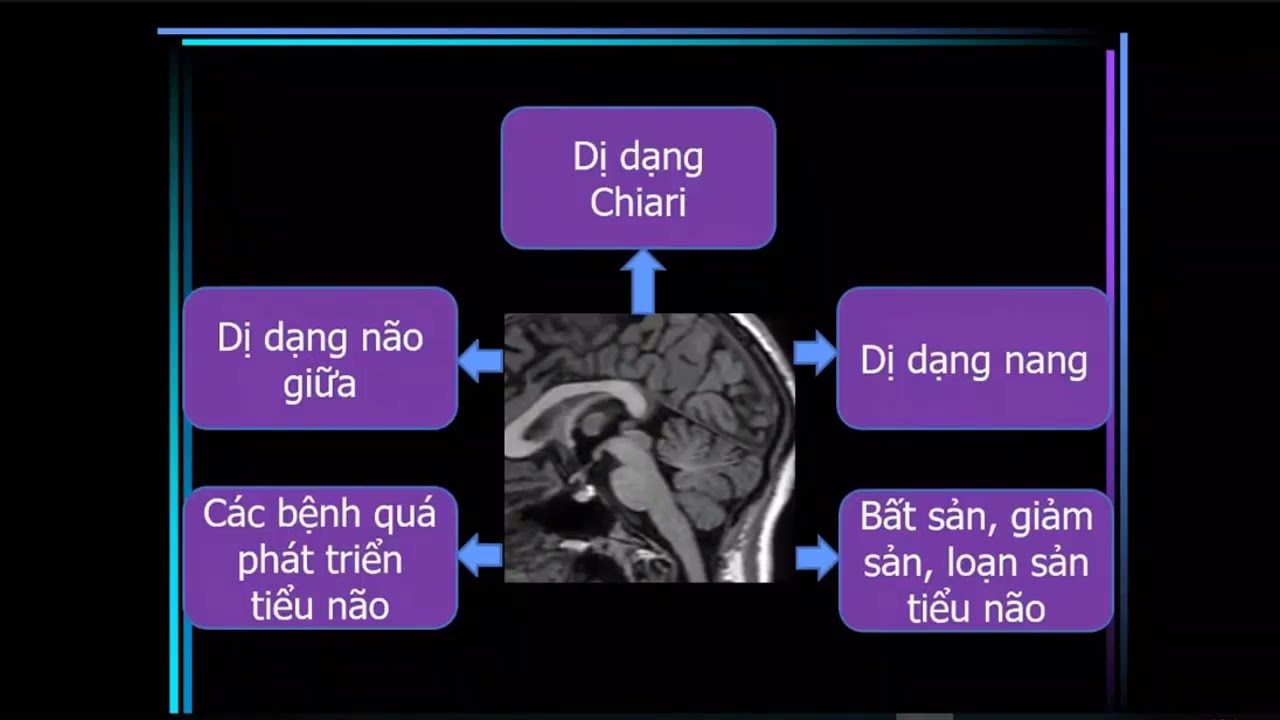 6. Hình ảnh bất thường bẩm sinh não - BS.CK2. Cao Thiên Tượng