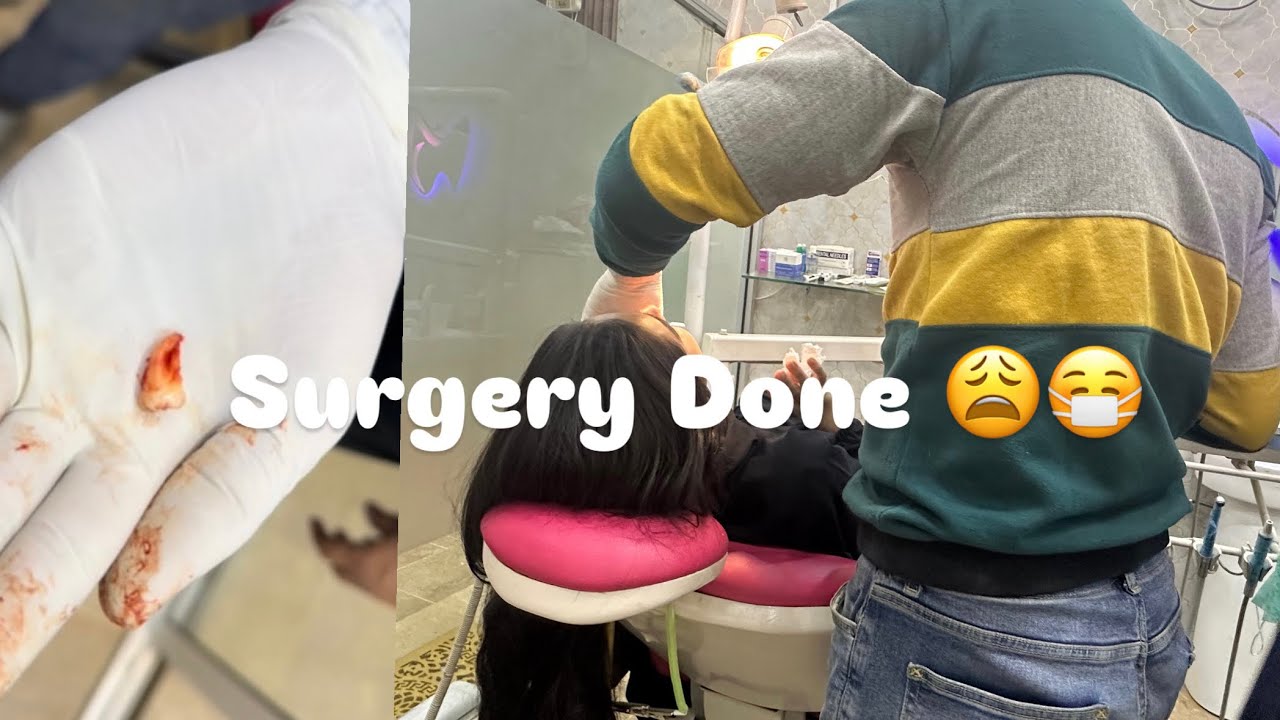 Wisdom Tooth removed!😷