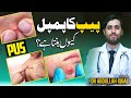 Got pusfilled boils discover the 5 types of abscess  simple pus ka ilaj  peep wale dano ka ilaj