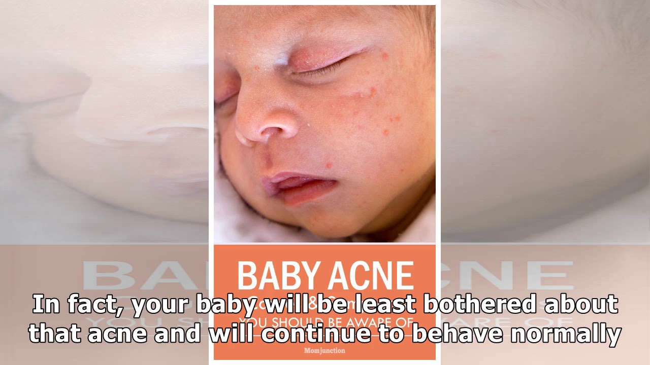 Baby Acne What Causes Them And How You Can Prevent YouTube