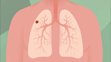 Qu'est-ce que le cancer bronchique ?