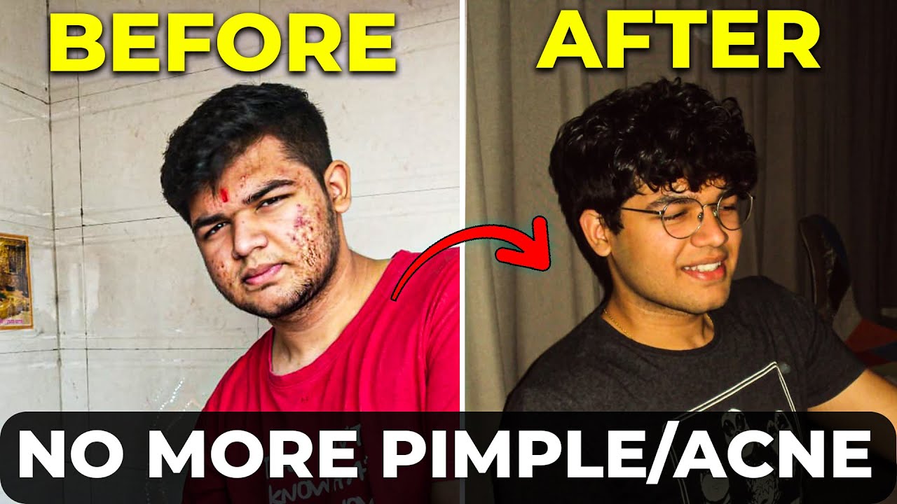 How I Fixed My Skin in 30 Days Permanently - YouTube