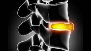 Chronic Pain Education 101 - Learn About Degenerative Disc Disease Best Practice Health Degenerative Disc Disease Explained