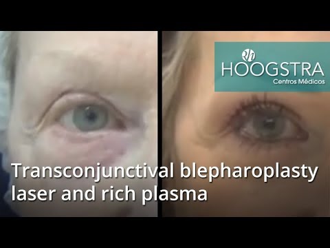 ultrasonido portatil Transconjunctival blepharoplasty laser and rich plasma (19054b)