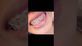 i pick Clark. #niche #clark #pink #braces #teal