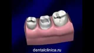 Лечение зубов красивая улыбка виниры коронки протезирование имплантация приятные цены(, 2014-03-25T19:35:33.000Z)