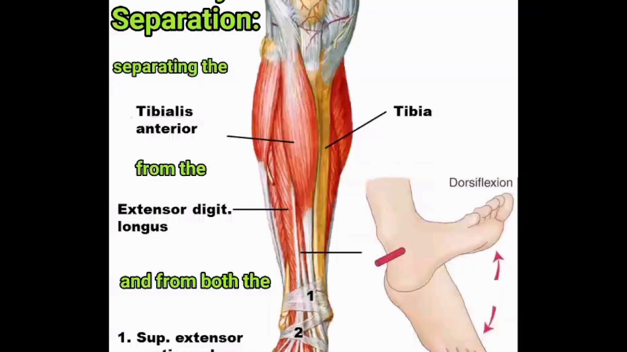 Sunday Separation: separating the Tibialis Anterior from the Extensor Digitorum Longus
