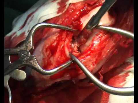 VI - Meniskuschirurgie